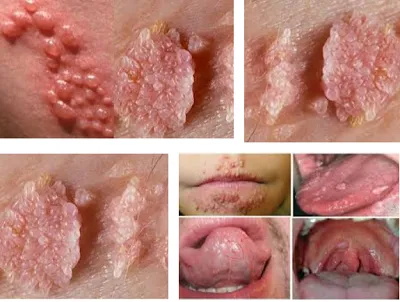 Sùi mào gà vùng sinh dục