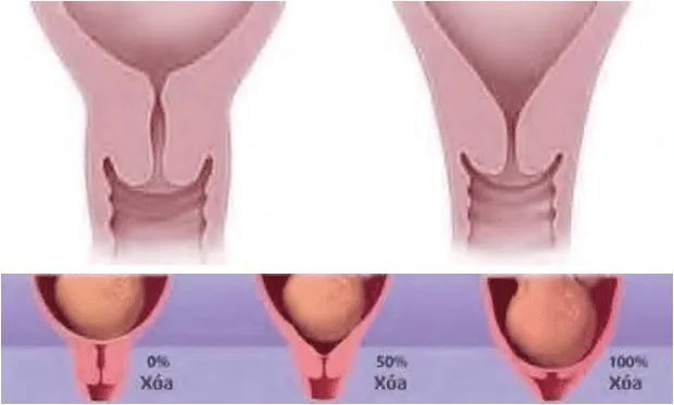 Xóa cổ tử cung